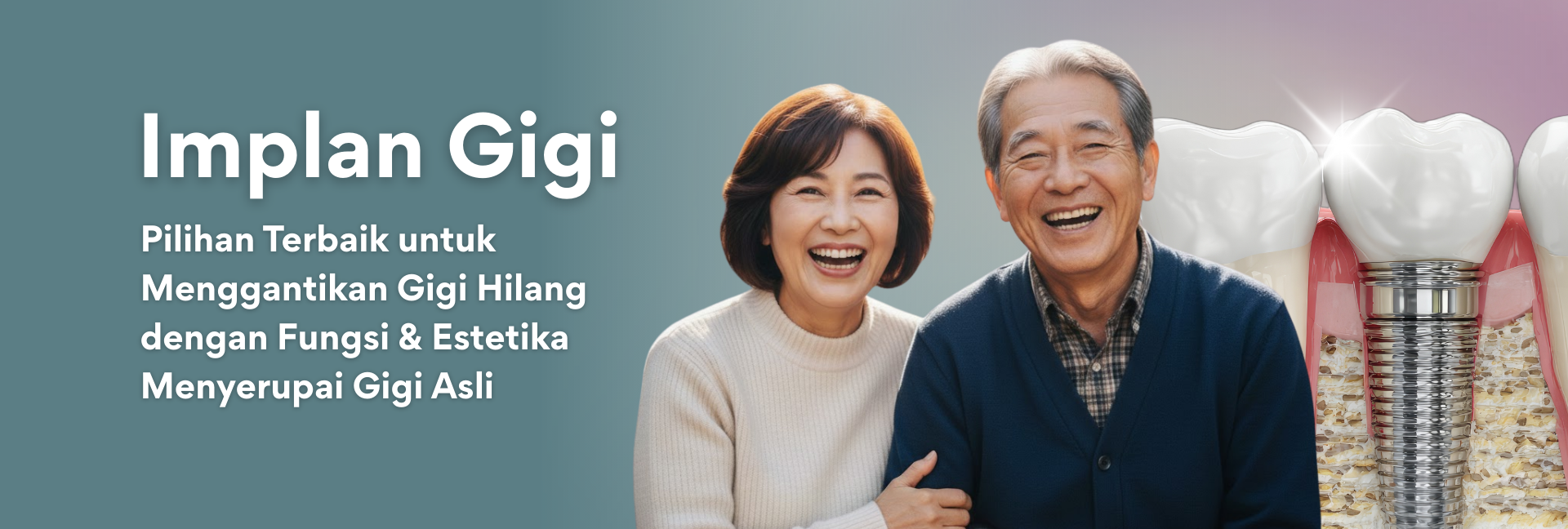 Implan Gigi